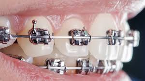 Braces