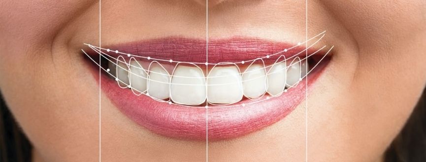 Smile Makeover